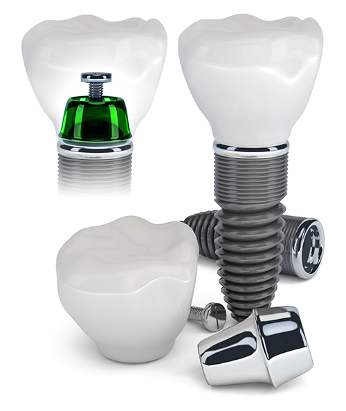 Hell's Kitchen Dental Implants