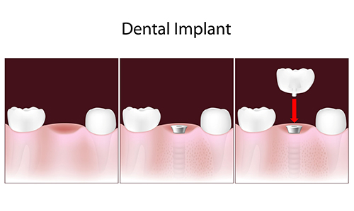 Midtown West Dentist Implants