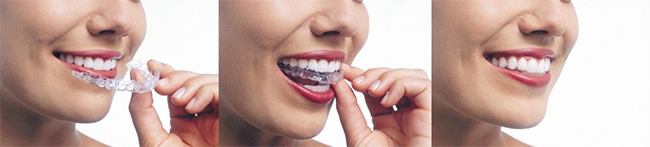 Invisalign 10036